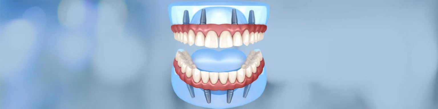 All On 4 Implants