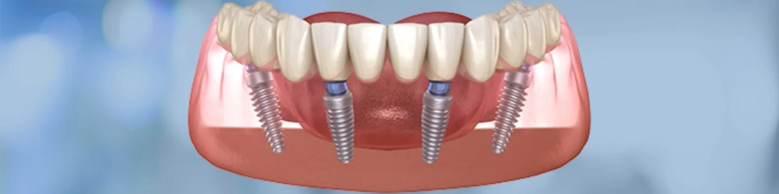 Implant Treatments