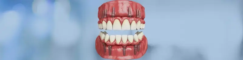 Straight Six Implants