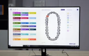 EXOCAD software for CAD designing of crowns, bridges as well as implant prostheses.