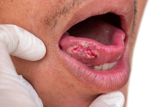 Alcohol and Oral Cancer: Understanding the Hidden Link