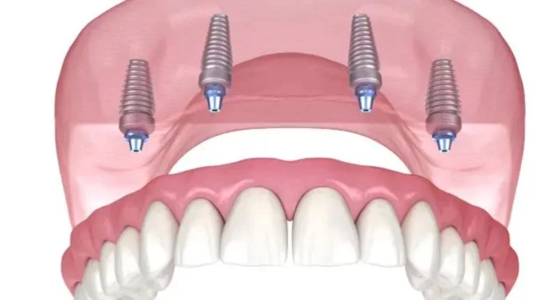 All On 4 Implants