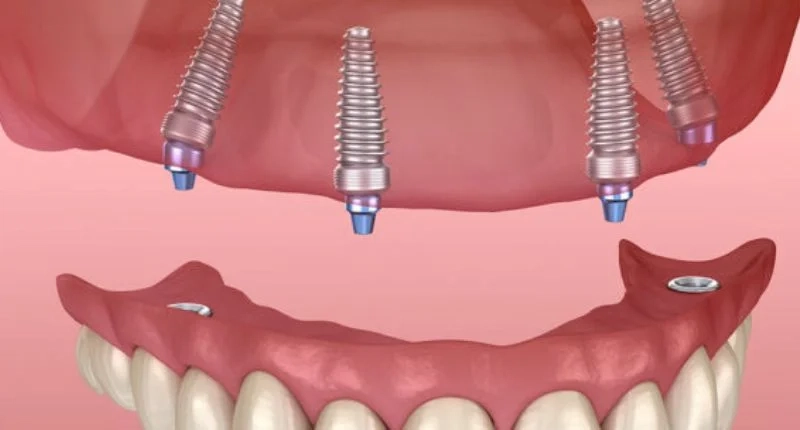 Implant Treatments