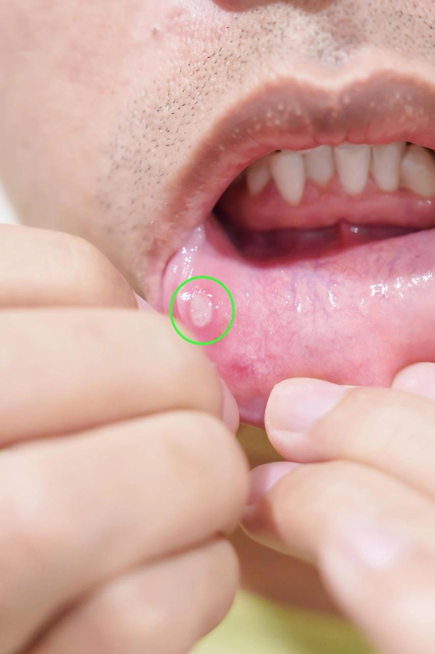 Persistent Mouth Ulcer? When Should You Get It Checked?