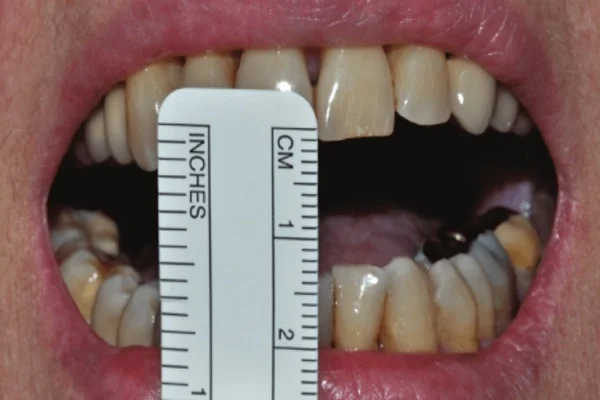 Oral submucous Fibrosis: A Common Precancerous Condition in India