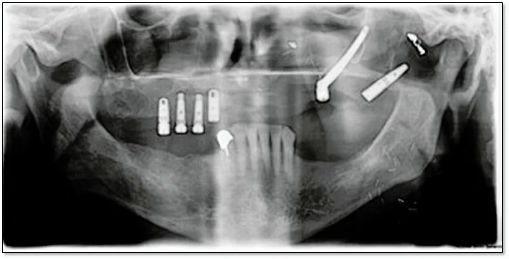 Pterygoid Implants