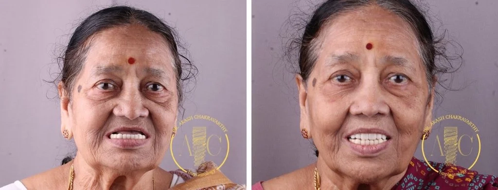 Smile transformation