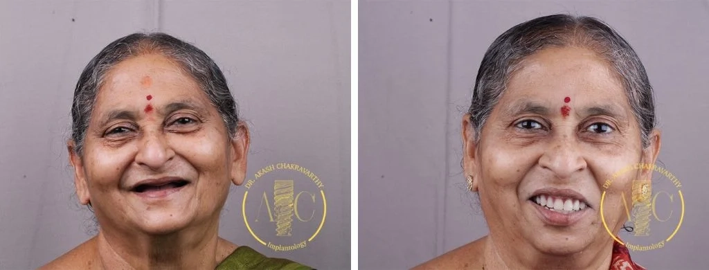 Smile transformation