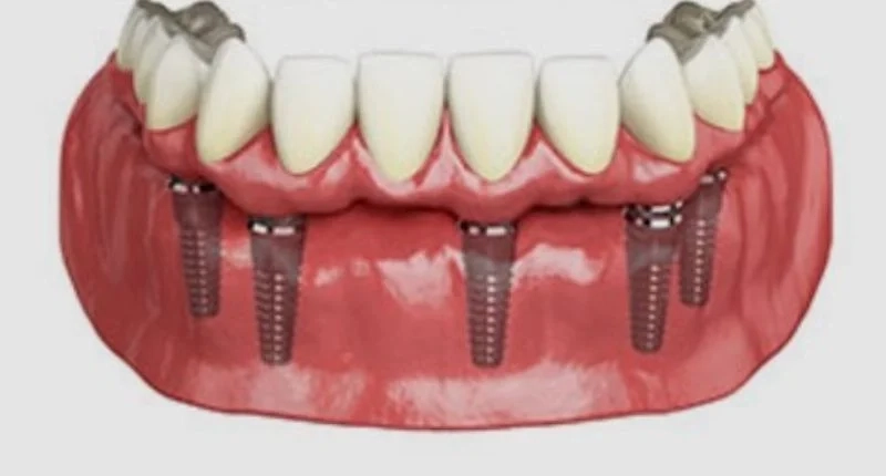 Straight Six Implants