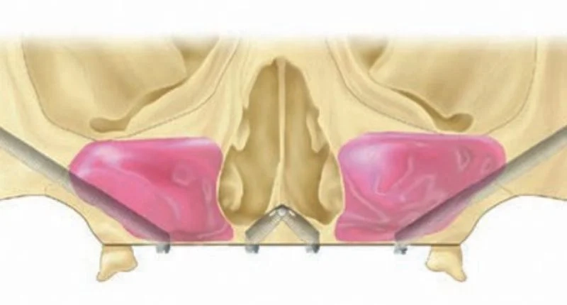 Zygomatic Implants