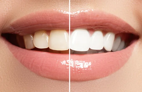 Teeth-Whitening