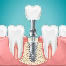 dental-implants